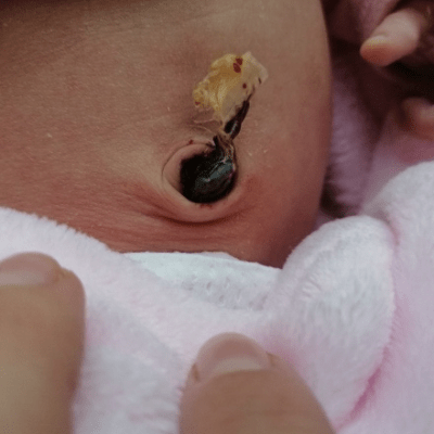 Pępek noworodka