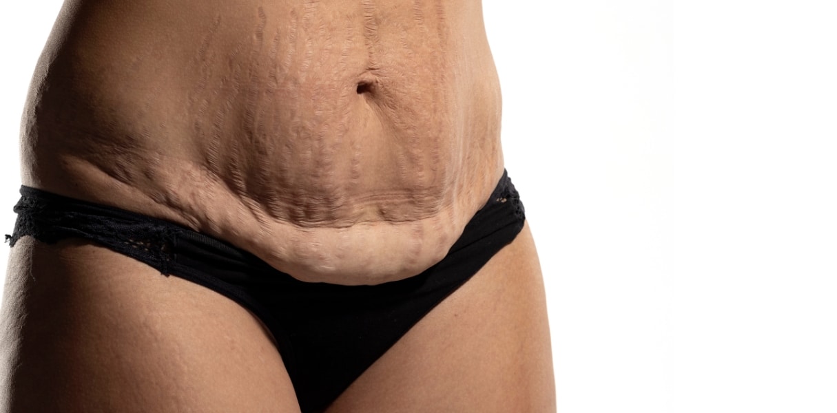 Wiotkie mięśnie po porodzie